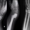 Fractures a la infància: què les diferencia dels adults i com poden afectar el creixement