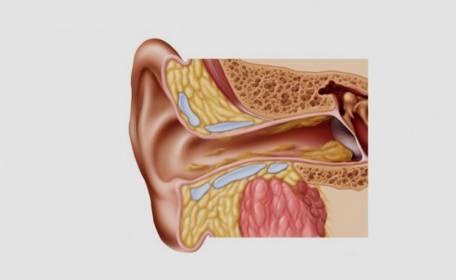 Cómo extraer la cera del oído de forma segura