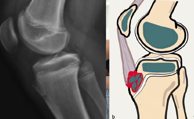 apofisitis osteocondrosis pediatrics lleida