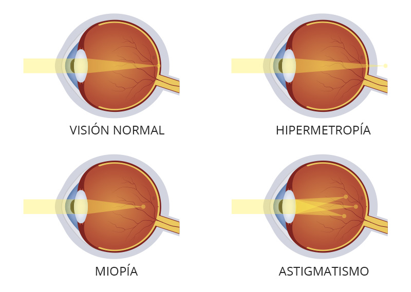 tipos vision pediatrics lleida