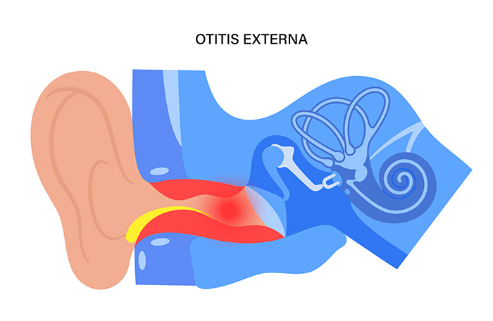 otitis externa esquema pediatrics lleida